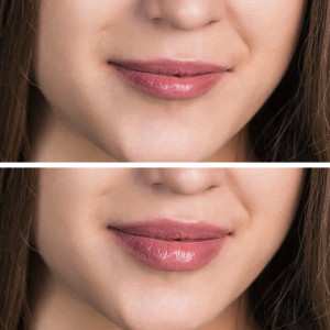 Beautiful female lips before and after augmentation